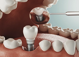 Implantes Dentales