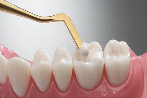 Restauración Dental